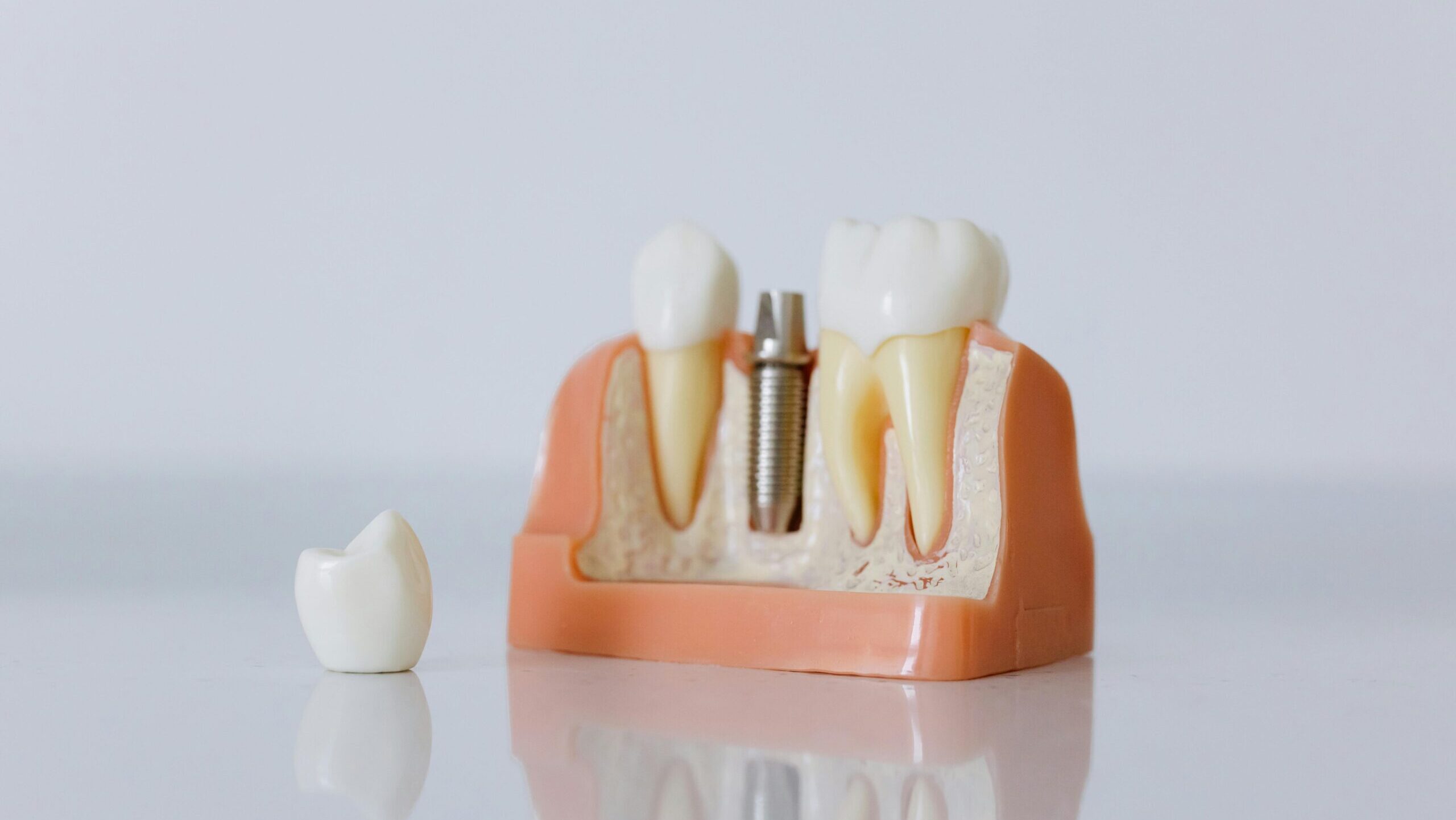implante dental illescas